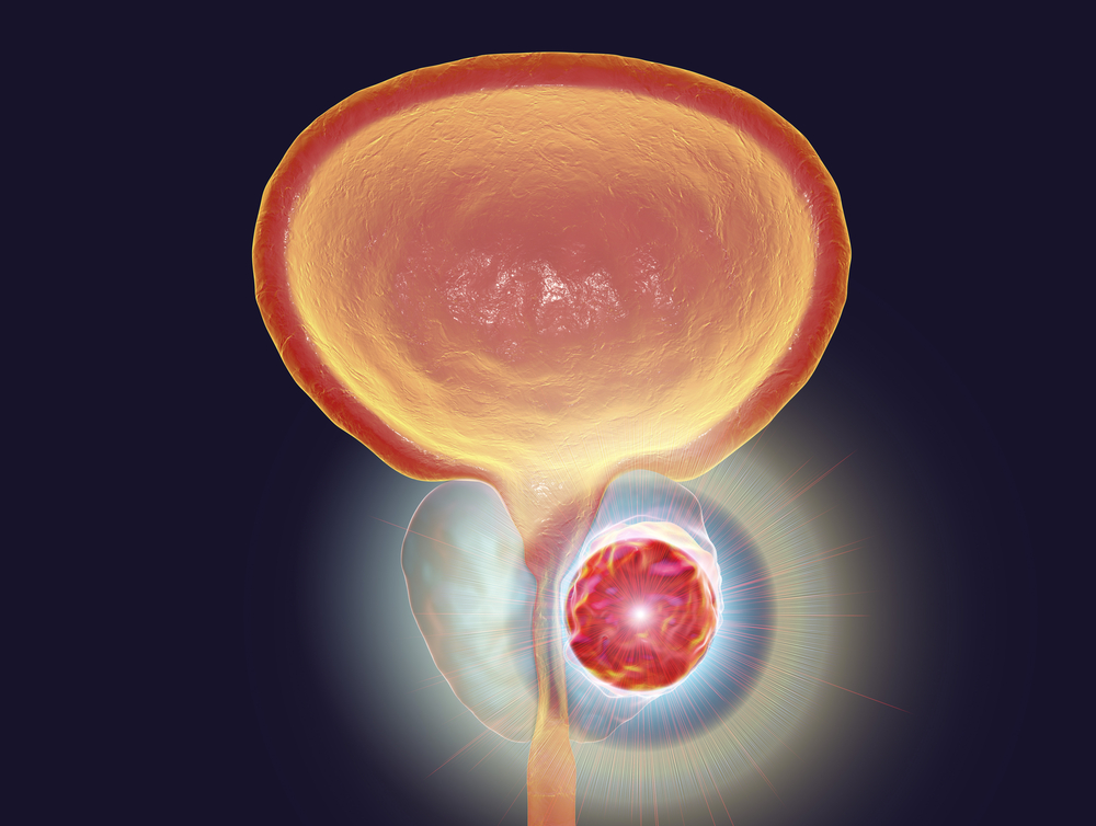 Prostate cancer treatment